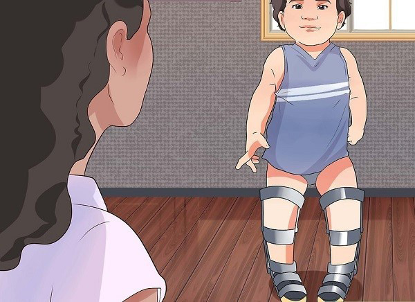 زانو ضربدری در پای کودکان 